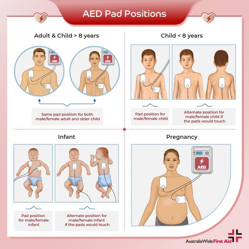 AED垫位置成人、儿童、婴儿和孕妇患者