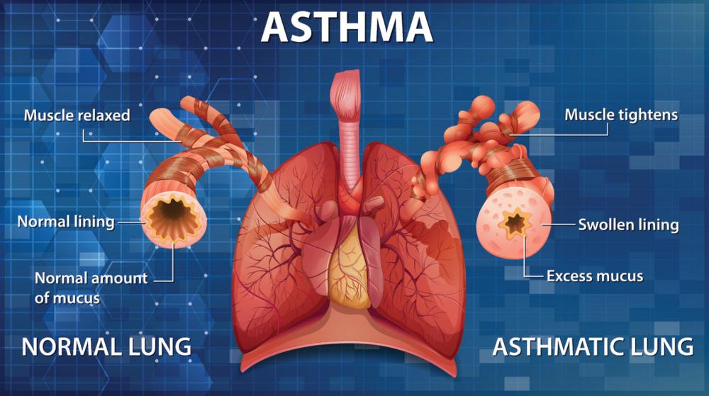 肺显示正常和哮喘肺