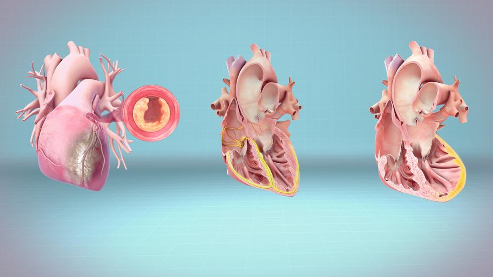 3D医疗动画仍然描绘心脏病发作，心脏骤停和心脏衰竭